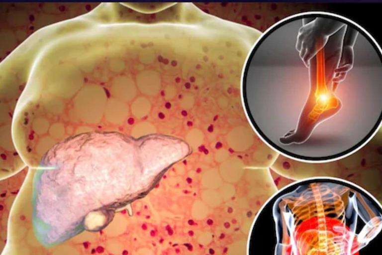 4 Body Organs That Can Get Affected By Fatty Liver Disease